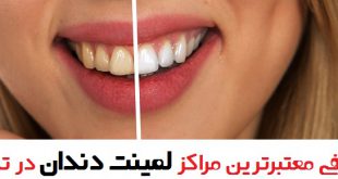 بهترین لمینت دندان در تهران