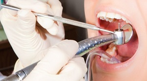 متخصص ریشه دندان در کرج