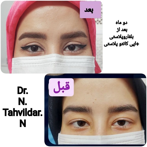 جراحی پلک در مشهد - نمونه کار دکتر تحویلدار نژاد