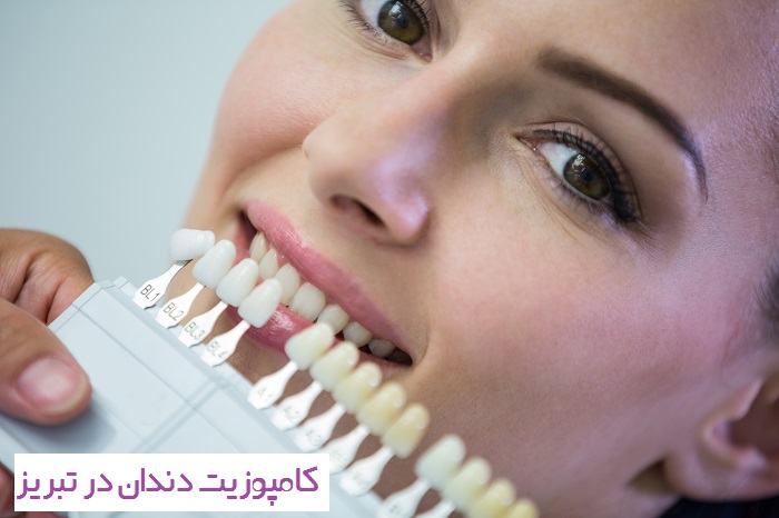 کامپوزیت دندان در تبریز